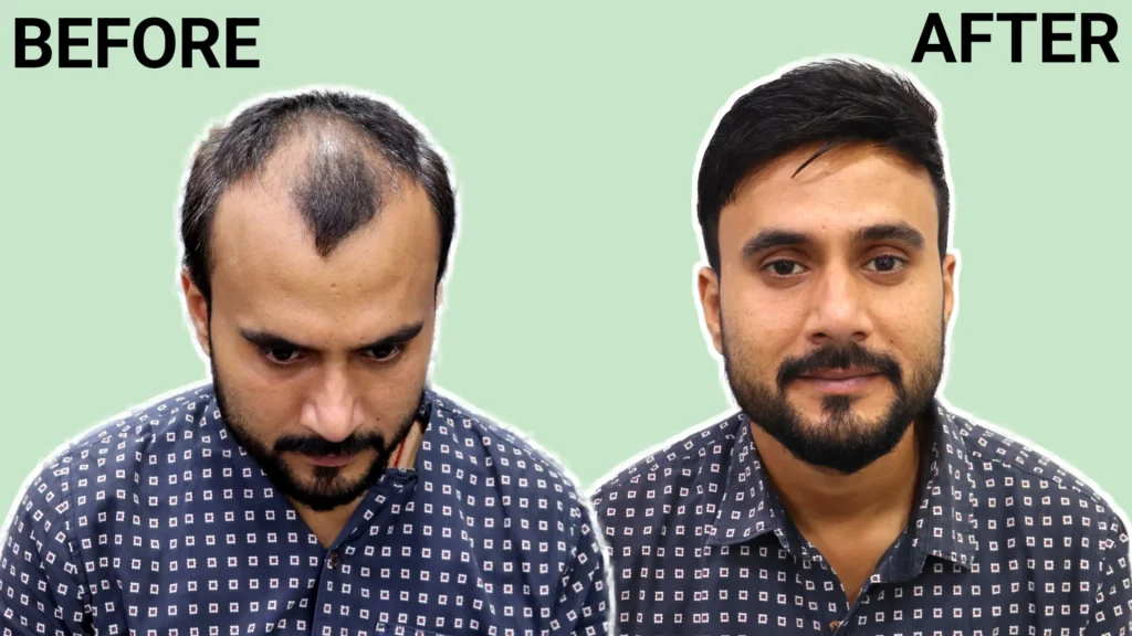 hair patch in nashik