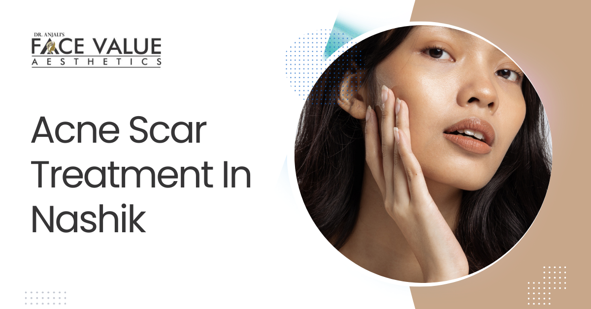 Acne Scar Treatment In Nashik