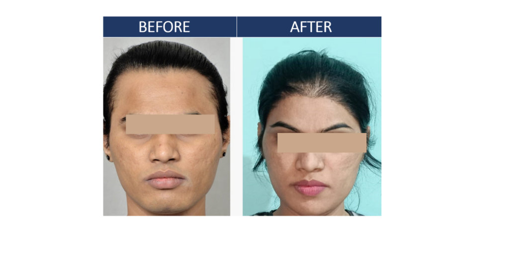 Best Facial Feminization by Dr. Anjali Manchanda in Nashik