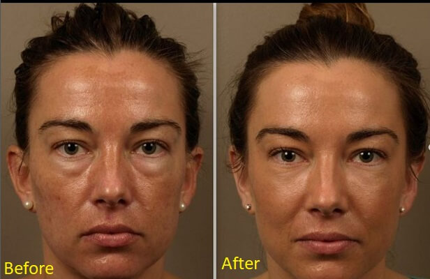 Recovery and results
facial implant