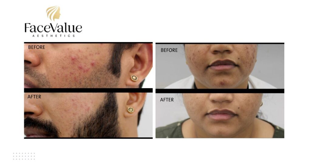 Best Laser Acne Scar Treatment In Nashik Before after result