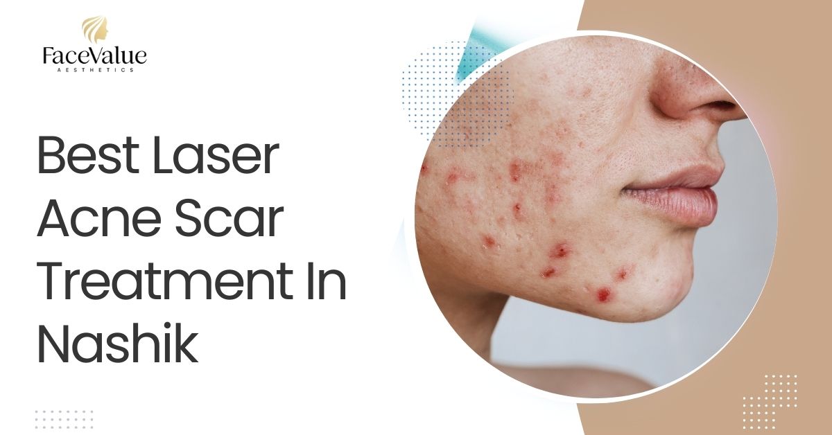 Best Laser Acne Scar Treatment In Nashik