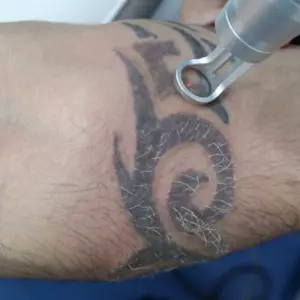 patient tattoo removal laser treatment